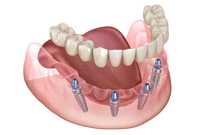 All on 4 Dental Implants in Bel Air