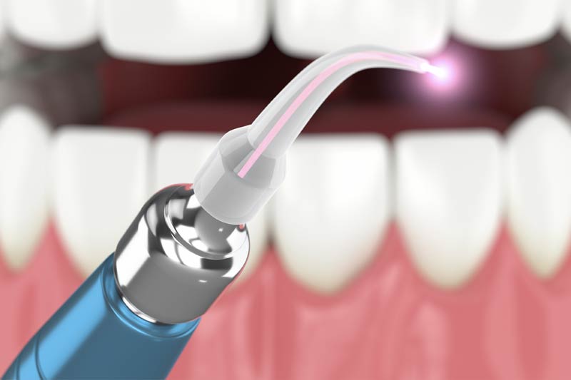 Laser Dentistry in Bel Air